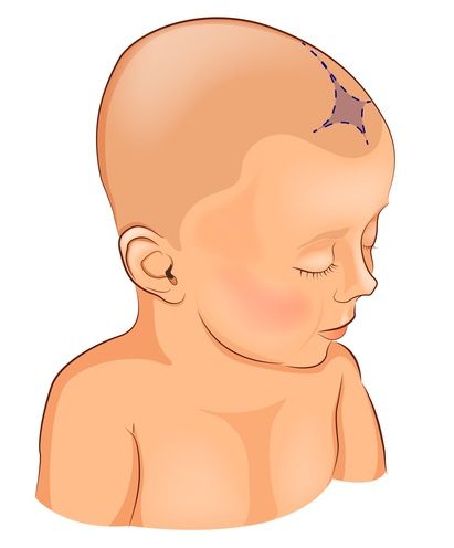 soft spot in infant's skull